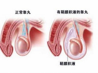 中医睾丸鞘膜积液的治疗方法